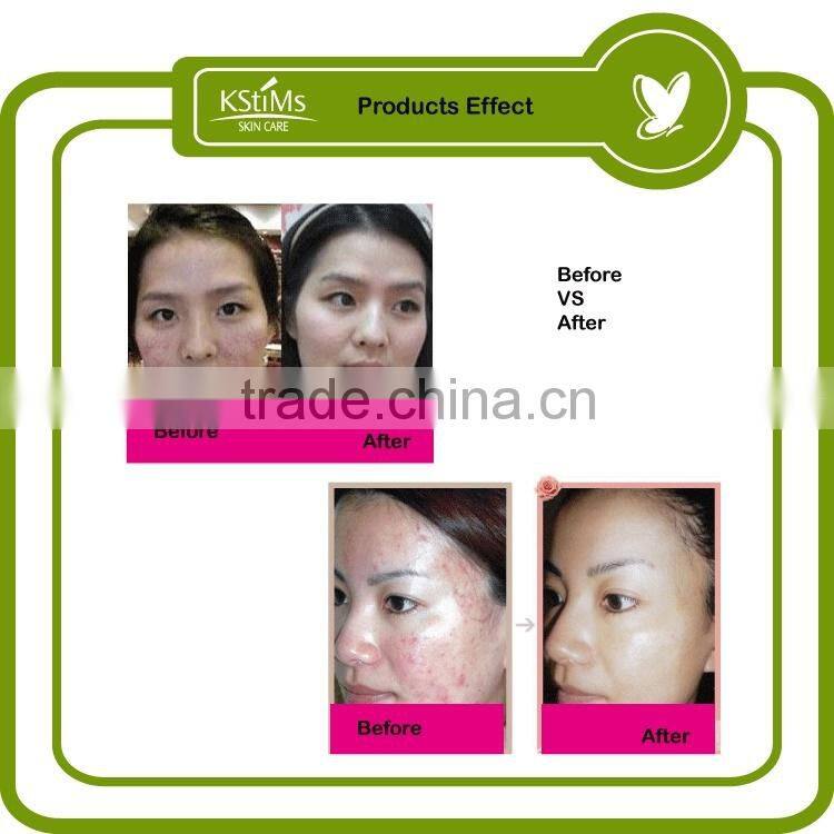 Natural herbal formula Tea tree oil Anti Acne and pimple treatment cream