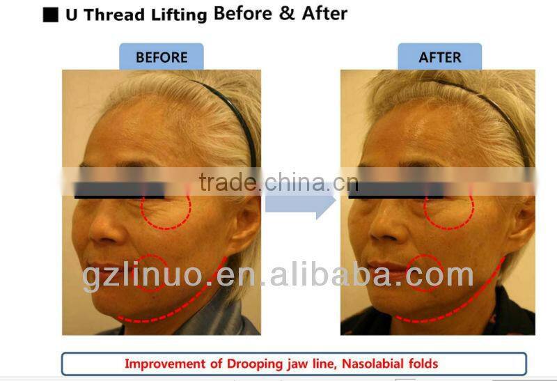 Cog face lifting PDO Thread