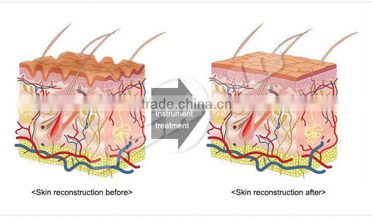 Fast And Efficient 800w Laser Hair Removal Machine Shr Ipl Opt Diode Laser