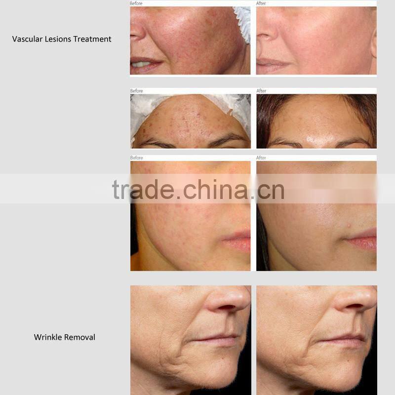 2016 new design IPL/Laser IPL machine/permanent IPL hair removal