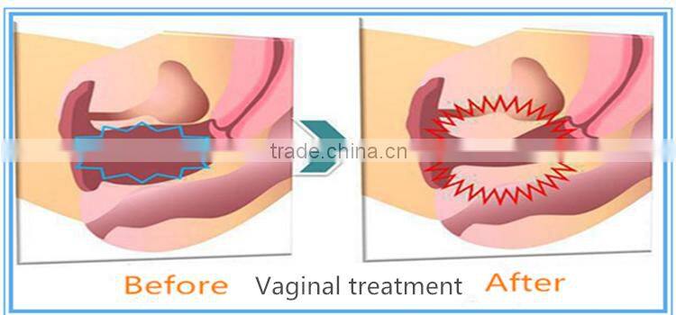 portable fractional rf metal tube co2 laser for virginal tightening