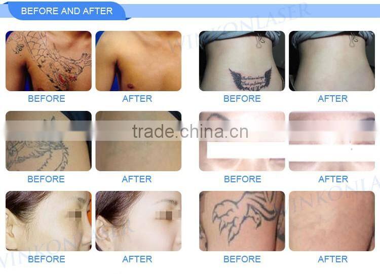 China supplier OEM ODM approved 2 years warranty laser rejuvi tattoo removal machine