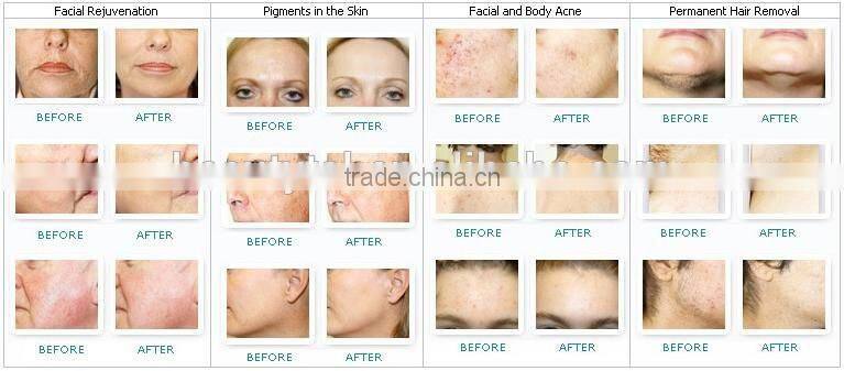 2016 new design IPL/Laser IPL machine/permanent IPL hair removal