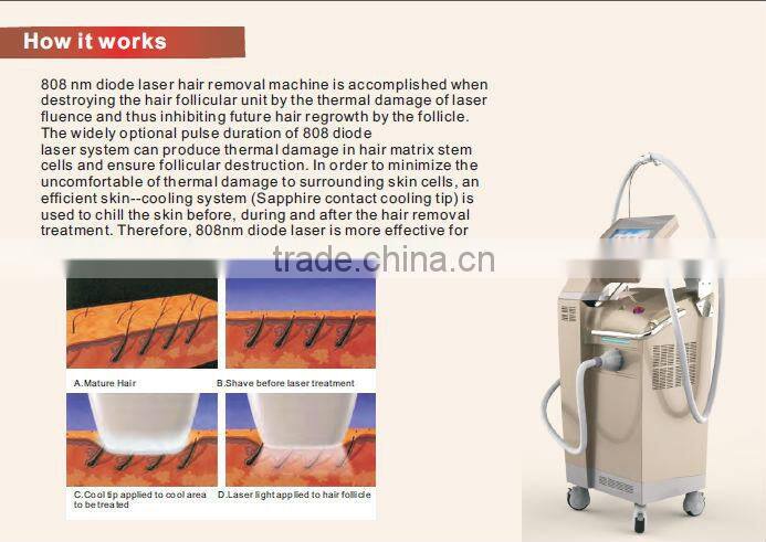 SHR high energy 808nm diode laser depilation
