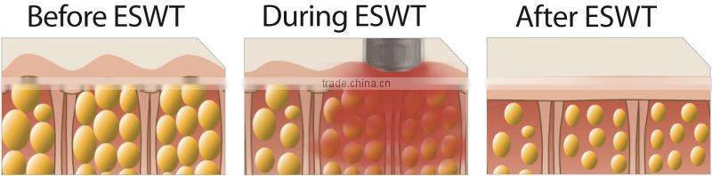 shockwave therapy machine for pain treatment