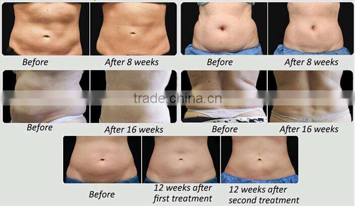 Fast body slimming freeze belly fat away / cryolipolysis device