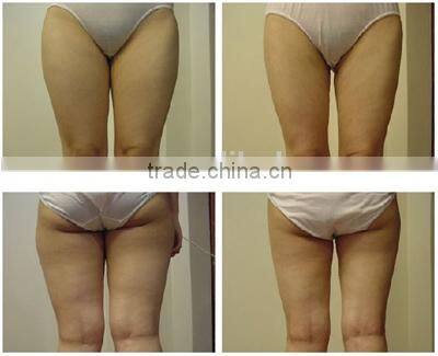 GS86 Weight loss Laser RF vacuum lipo cavitation machine