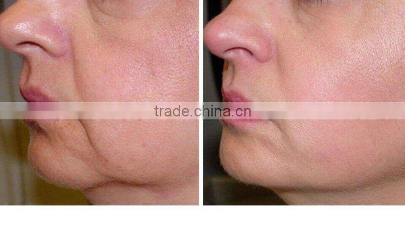 2016 Distributor wanted acne scar removal body permanent hair removal ipl elight shr hair removal machine