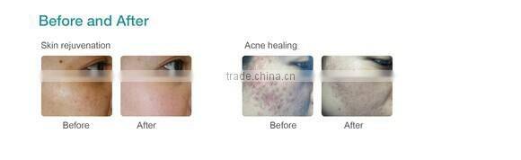 Apolo med LED PDT therapy for acne scar wrinkle PDT red light therapy portable