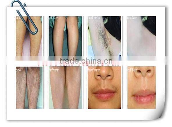 IPL SHR laser hair removal machine with touch screen