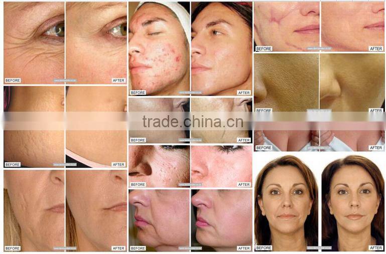 2017 Hot sale rechargeable derma pen Dr.pen M5 electric dermapen Microneedling Dermapen with Needles Cartridges