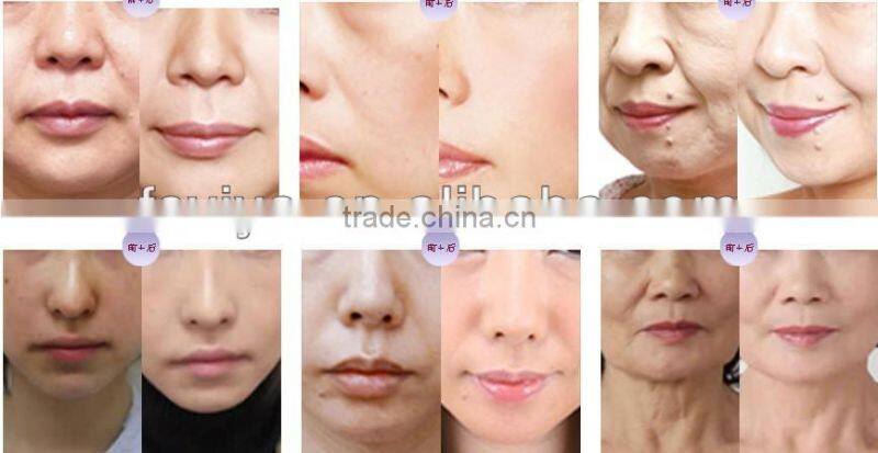 F998 Anti-aging Fractional RF Microneedling Face Treatment
