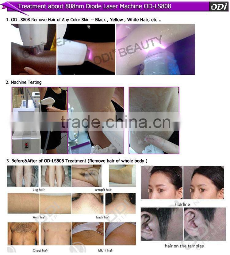 OD-LS808 Best selling hot painless depilation 808 diode laser machine