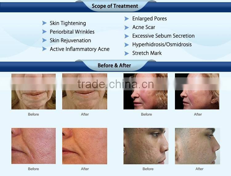 non surgical face lift machine / fractional rf microneedle