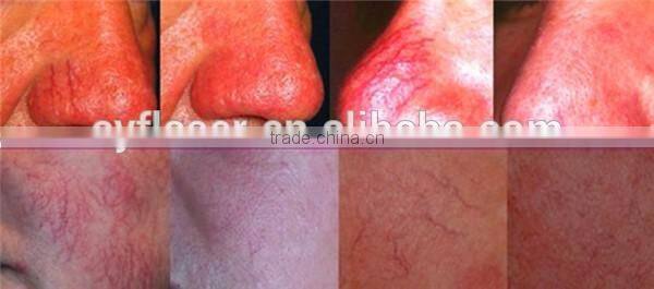 high frequency thermolysis radio frequency spider vein removal machine