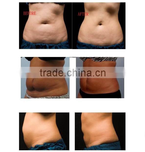 VG-606C Poratale ultrasonic facial blackhead extraction machine with Ultrasound &Vacuum liposuction function