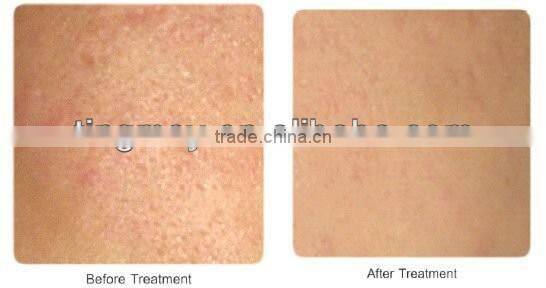 Photon micro needle 540 pins dns derma roller tm-089