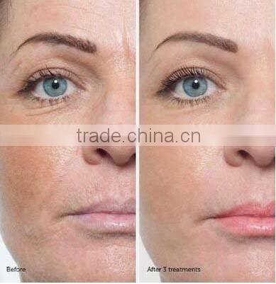 NL-DT200 Hot ! Micro Crystal diamond dermabrasion facial and cleansing make skin revitalizer beauty machines