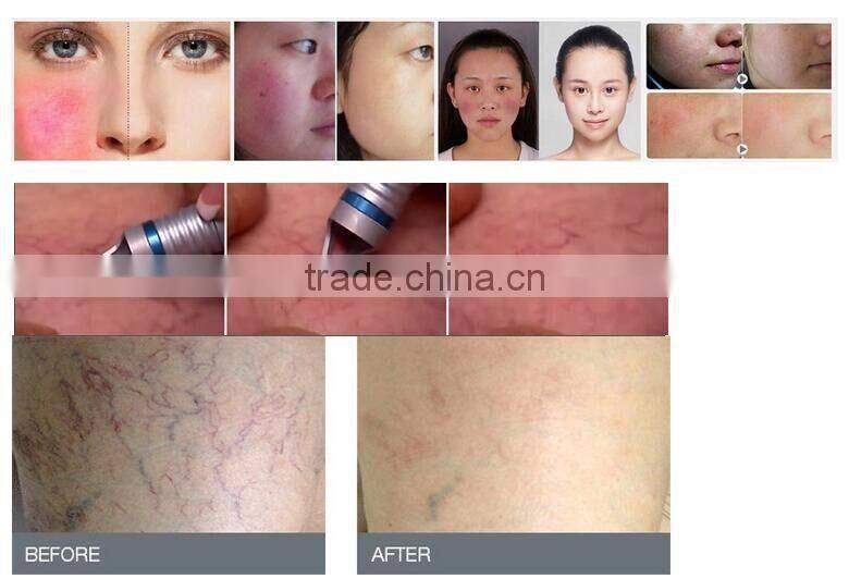 980nm spider vein removal machine Telangiectasis Vascular Removal /Spider Vein Removal Machine 980nm laser 30w POPIPL