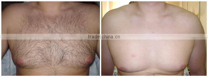 600w epilator laser 808nm diode permanent hair removal machine