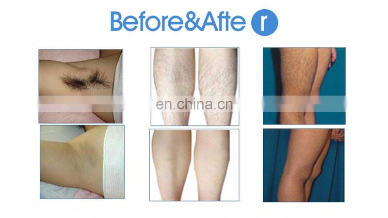 Super fast freezing cool shr opt hair removal machine shr diode laser hair removal