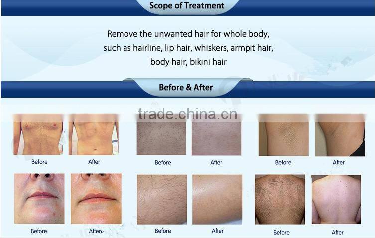 Newest most popular diode laser hair removal Clinic Medical Use 810nm Hair Removal Laser Diode Machine