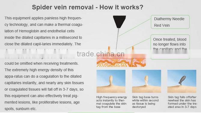 Varicose Veins Laser Treatment Diode Laser 980nm Machine RBS02