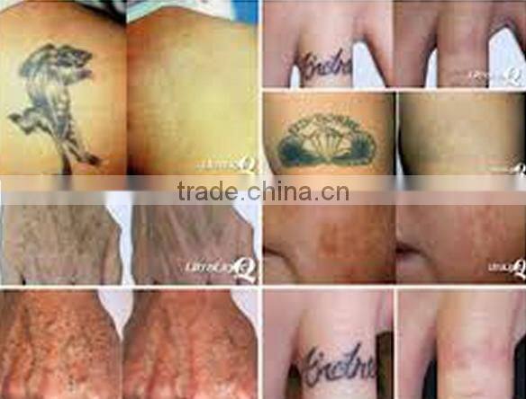 Beauty equipment tattoo removal machine multifunction Q Switched Nd Yag Laser device