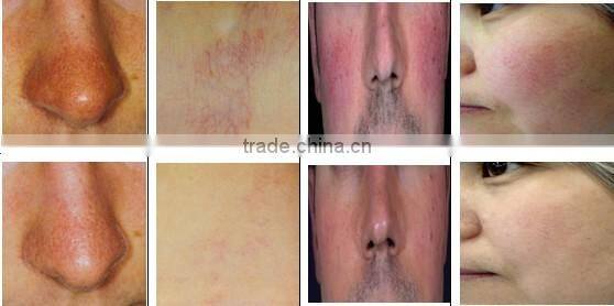 980nm diode laser medical CE HOT! Vascular Vein Removal Machine/ Spider Vein Removal