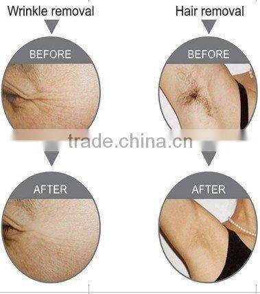 WL-03 E-light (ipl+rf) skin care and hair removal machine