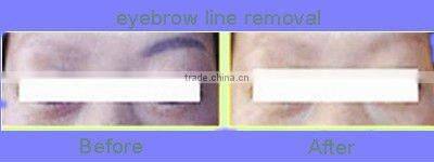 eyebrow line removal laser beauty equipment