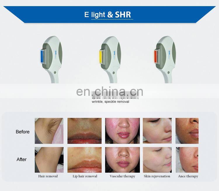 Two Handpieces elight ipl+rf hair removal skin rejuvenation anti redness