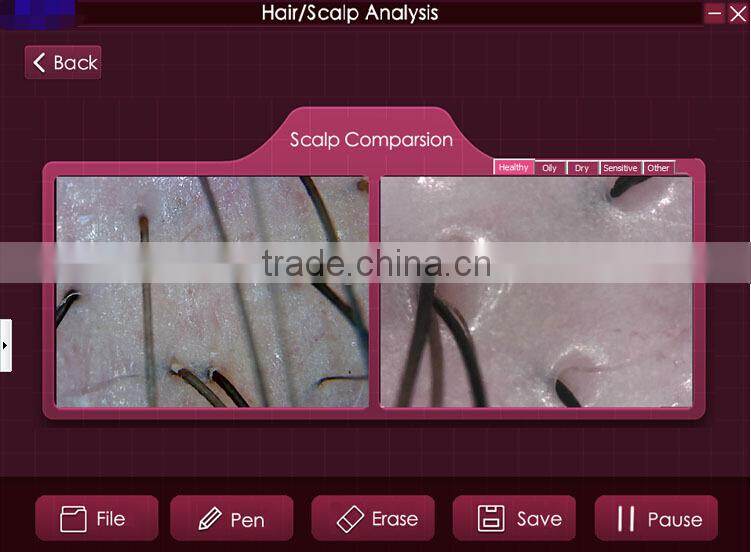 200X digital microscope scalp detector