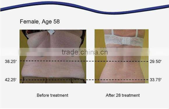 hot selling fitness equipment body slimming machine