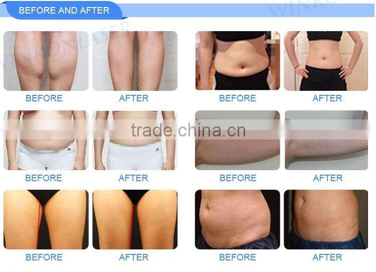 cryolipolysis cool shaping machine / cryolipolysis slimming with RF CAVITATION multifunction system