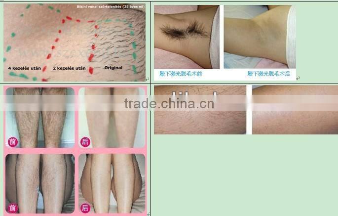 TOP SPA SHR IPL Laser Equipment