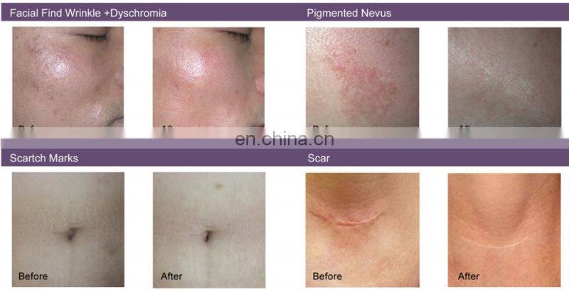 LFS-D2 Pain free vertical fractional co2 laser machine dermatology