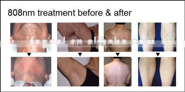 New portable 2015 professional laser diode 808 nm (CE)