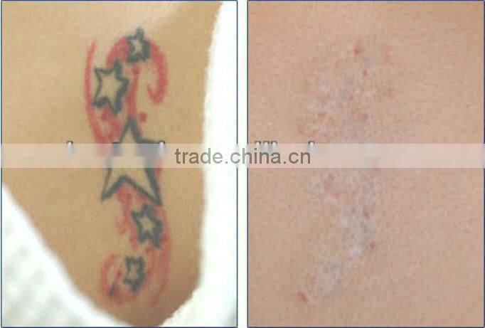 532nm,1064nm,1320nm q switched nd yag laser tattoo removal