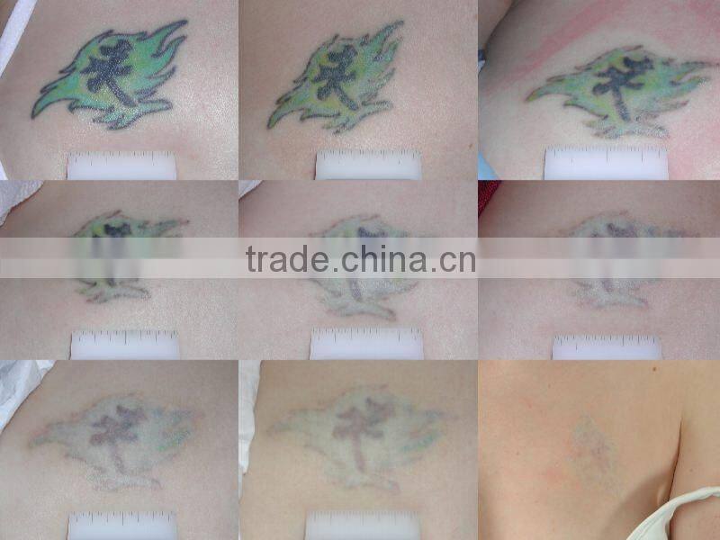 Professional ruby tattoo removal machine q switch nd yag laser treatment