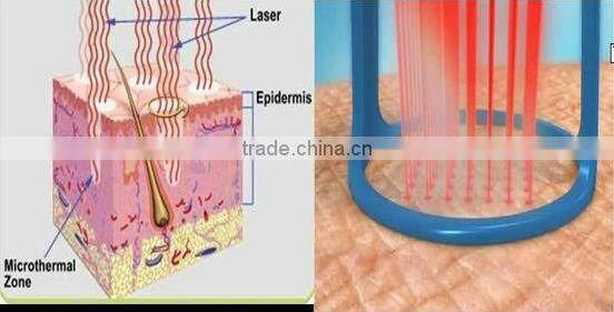 2016 Newest vertical salon use co2 fractional laser beauty equipment