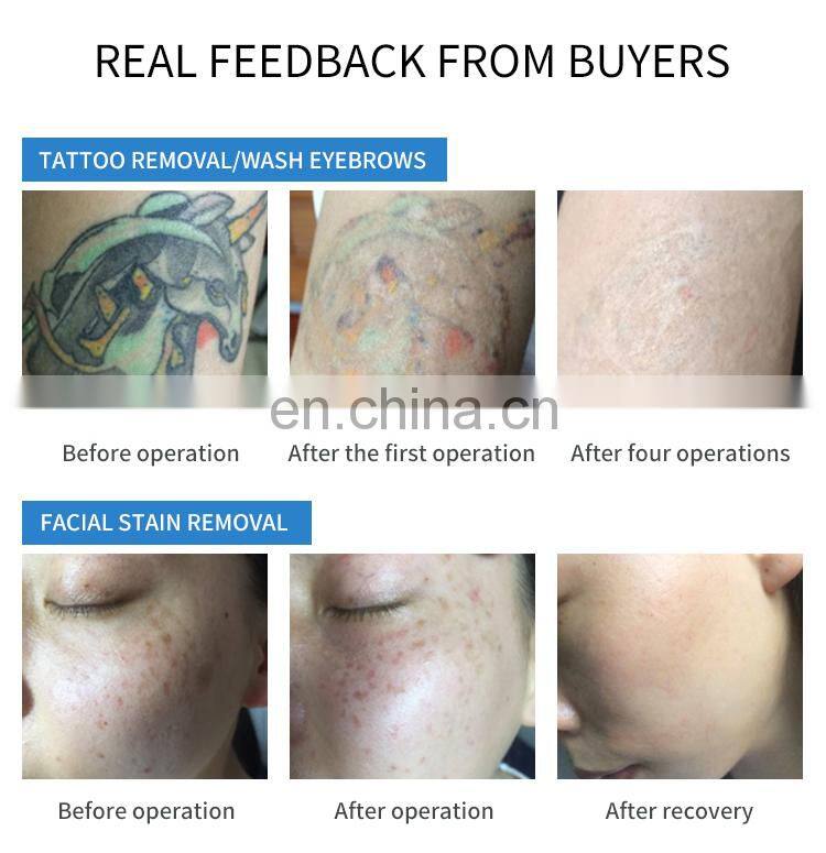 Factory ND Yag Laser Machine Professional Tattoo Removal Laser Instrument Eyebrow Pigment Removal Beauty Machine