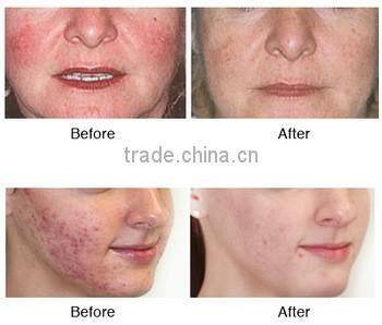 AYJ-Y71A CE acne treatment skin care acne clear removal machine