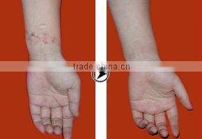 Multi-function fda approved RF co2 Fractional Laser for Skin Rejuvenation