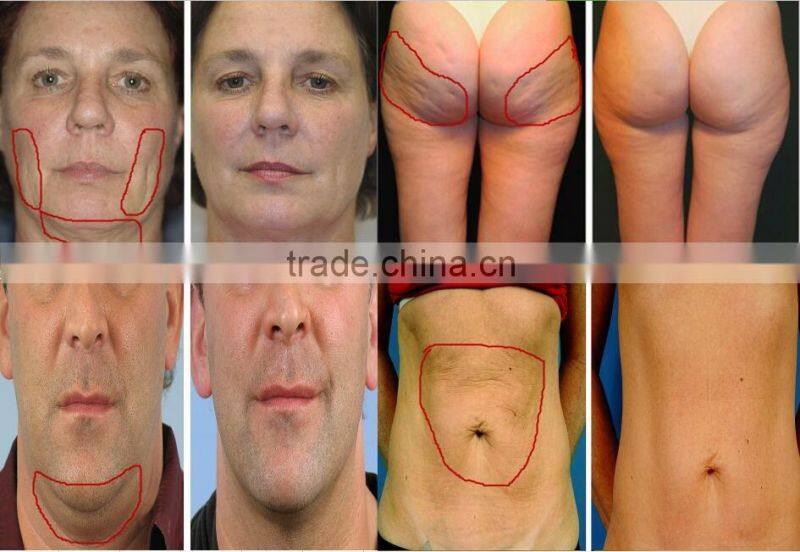 AYJ-T29(CE) Professional CPT fractional rf device for anti-wrinkle