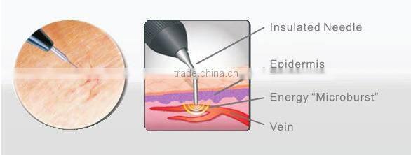 Rbs 30Mhz high frequency spider veins removal vascular therapy machine