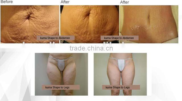 Whole sale weight loss belt for distrubutor