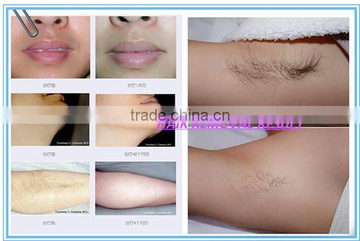 depiladora laser diode 808 for permanent hair removal