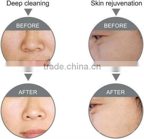 hydro-microdermabrasion machine/diamond peeling dermabrasion machine/3 functional diamond HO2A