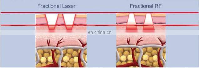 2015 Matrix Fractional Microneedle RF& microneedle Fractional RF for face lifting with CE, ISO